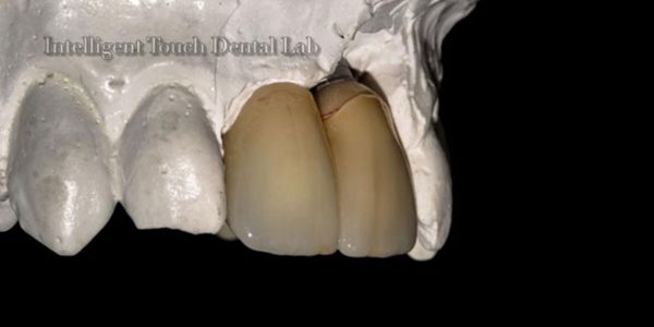 Crowns and Bridges at Intelligent Touch Dental Laboratory